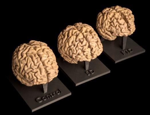 Three 3D printed brains, labelled 'Control', '5D' and 'FTD'