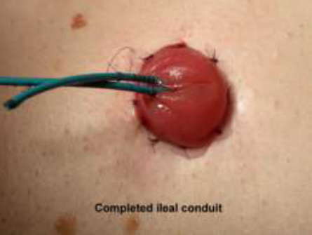 Completed ileal conduit
