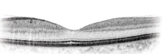 Illustration of cross-section of healthy macula
