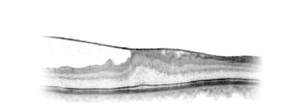 Illustration of cross section of macula with Epiretinal Membrane
