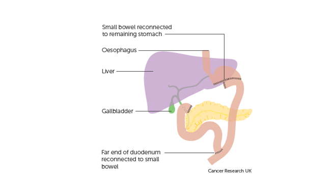 Illustration of the stomach after a distal/ Subtotal gastrectomy, labelled from the top to bottom are: small bowel reconnected to remaining stomach, Oesophagus, Liver, Gallbladder and far end of duodenum reconnected to small bowel