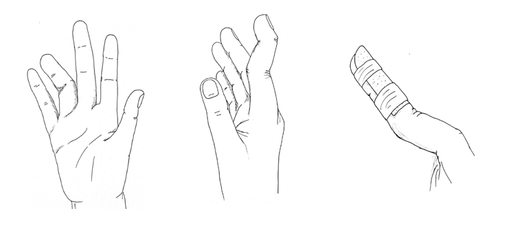 Illustration of mallet finger injury. Third finger is bent and index finger is bent