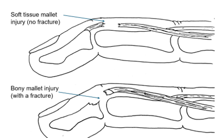 Illustration of two mallet fingers. The top illustration is a soft tissue mallet injury (no fracture). Bottom illustration is a bony mallet finger (with fracture).