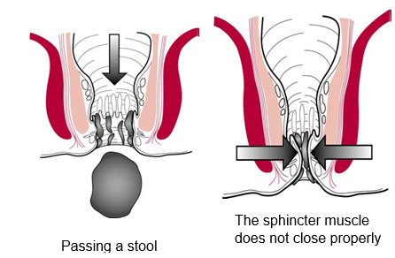 Two Diagrams of passing a stool and what happens after, type reading: 'passing a stool' 'the sphincter muscle does not close properly'