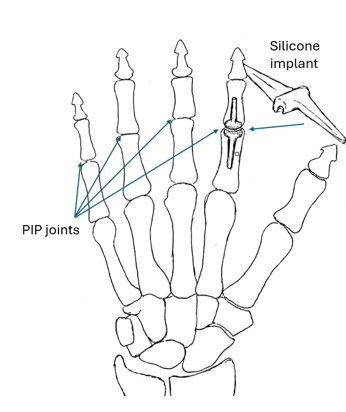 Diagram of a skeleton hand with arrows pointing to the PIP joints and an arrow indication where the silicone implant is on the index finger