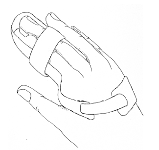 Illustration of right hand in a splint