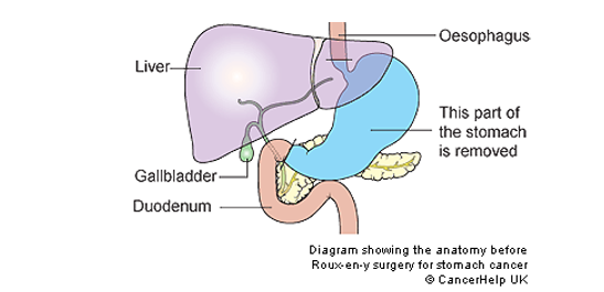 Illustration of the stomach labelled going clockwise: oesophagus, part of the stomach that is to be removed, duodenum, gallbladder and liver