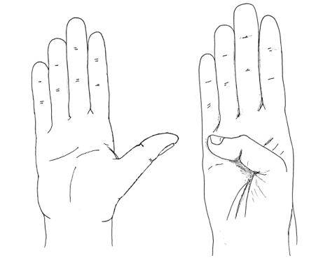 two illustrations of right hand with the first image showing the thumb stretched out away from the palm and the second showing the thumb bent forwards across the palm