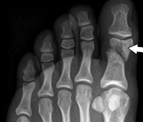 X-ray showing fractured great (big) toe.