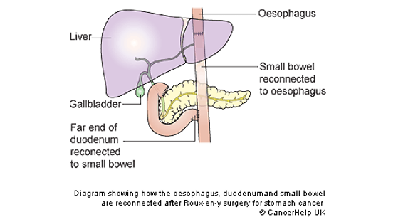 Illustration of the stomach after a total gastrectomy, labelled from clockwise: oesophagus, small bowel reconnected to oesophagus, far end duodenum reconnected to small bowel, gallbladder and liver