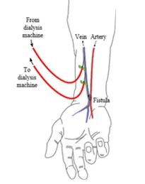 Diagram drawing of a hand and forearm where the vein has been surgically connected to the artery. The dialysis machine can then be connected to the vein via inflow and outflow needles.